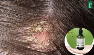 Gia công dầu gội đầu trị nấm