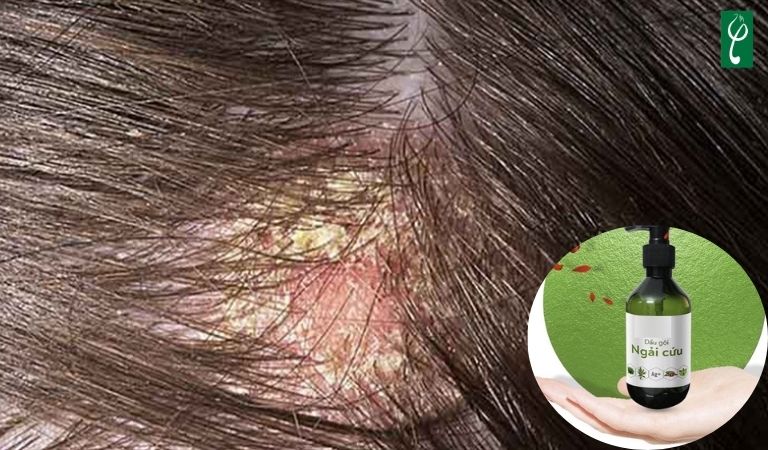 Gia công dầu gội đầu trị nấm