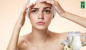 Da mụn có nên dùng sữa tươi rửa mặt không
