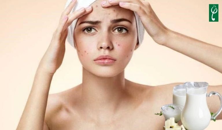 Da mụn có nên dùng sữa tươi rửa mặt không