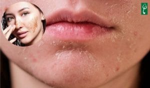 Gia công gel tẩy tế bào chết cho da khô