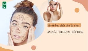 Gia công gel tẩy tế bào chết cho da mụn