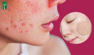 Gia công gel tẩy tế bào chết cho da nhạy cảm