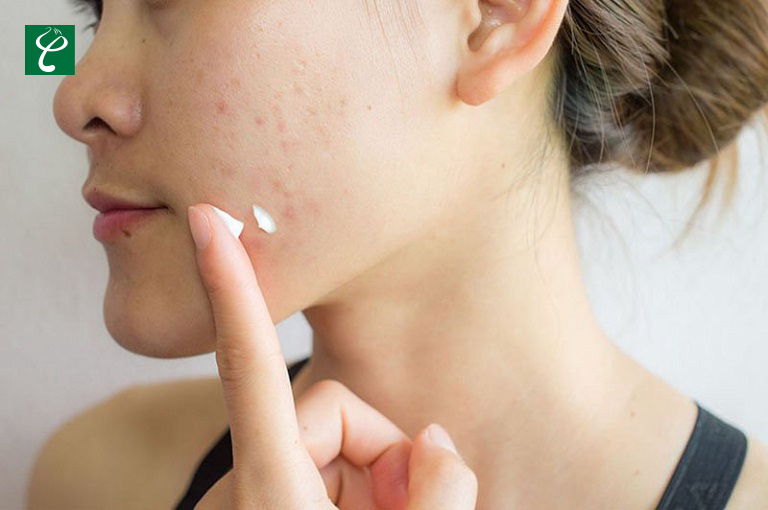Bôi kem chống nắng là thao tác không thể thiếu để bảo vệ làn da mụn