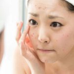 Da mụn có nên dùng kem chống nắng