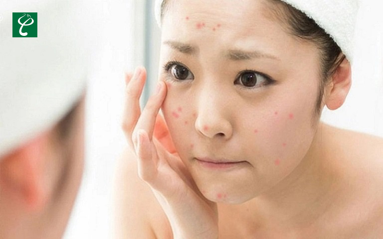 Da mụn có nên dùng kem chống nắng