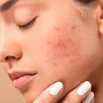 Dị ứng kem chống nắng