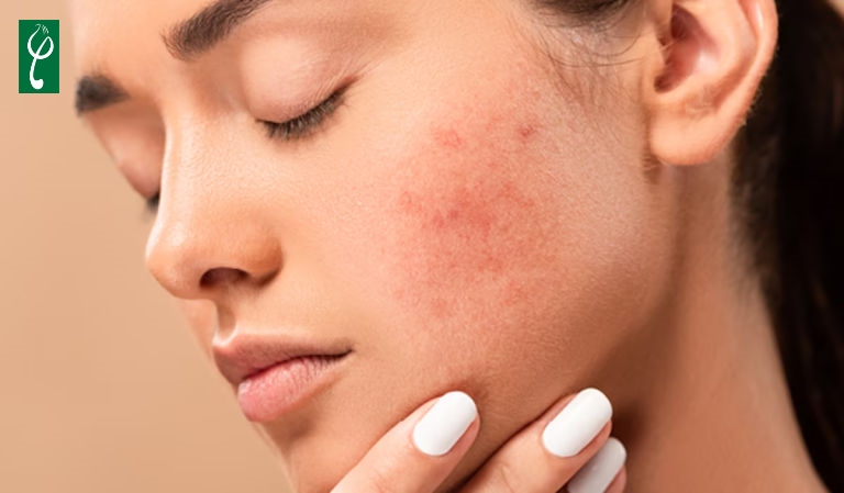 Dị ứng kem chống nắng