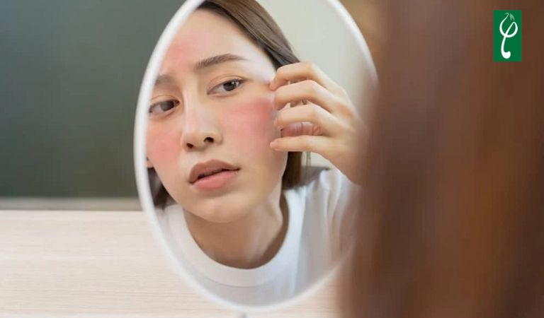 Dùng kem chống nắng không đúng cách dễ gây đen sạm hoặc bít tắc lỗ chân lông gây mụn